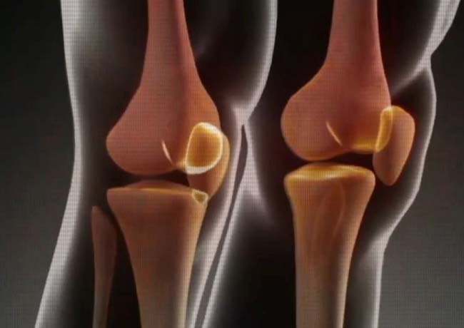 伤膝黑名单丨想要膝盖“长寿” 少做这5件事